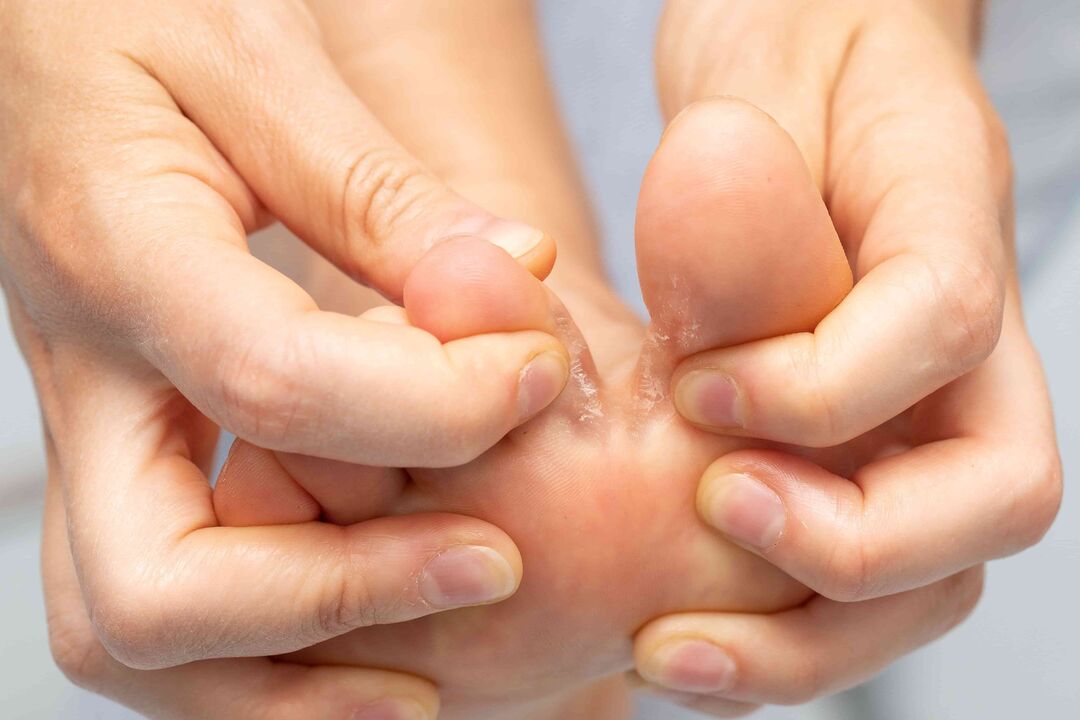 Fungo tra le dita dei piedi e il suo trattamento con Zxcvbnmqwert Cream