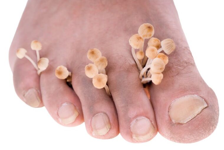 Fungo sui sintomi delle gambe